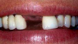 Choose Dental Implants by Gurnee Expert Dr. Bradley Rule!