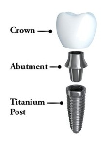 Dental Implants: An Investment in Yourself!