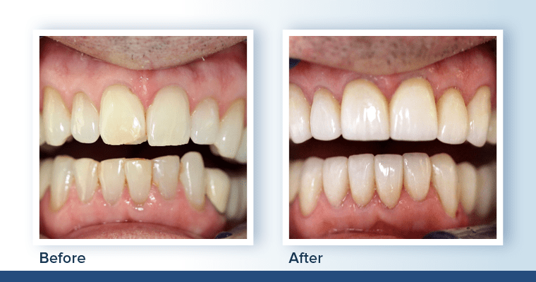 Tom's before and after veneers and crowns photos