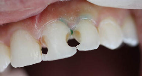 Unhealthy front teeth with holes