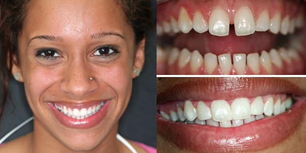 A female patient smiling with her before and after images next to her