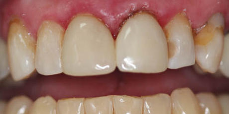 Fractured tooth restored with composite material