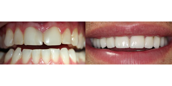 Before and after procedures smile collage