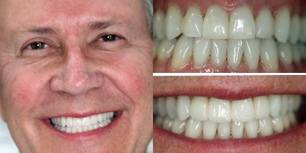 A male patient smiling with his before and after images next to him