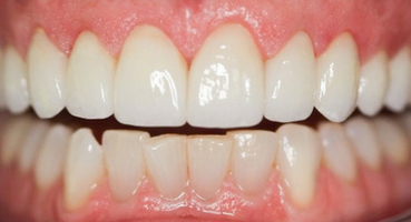 A perfect smile made with porcelain veneers