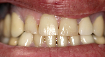 Discolored, short, worn teeth with spaces