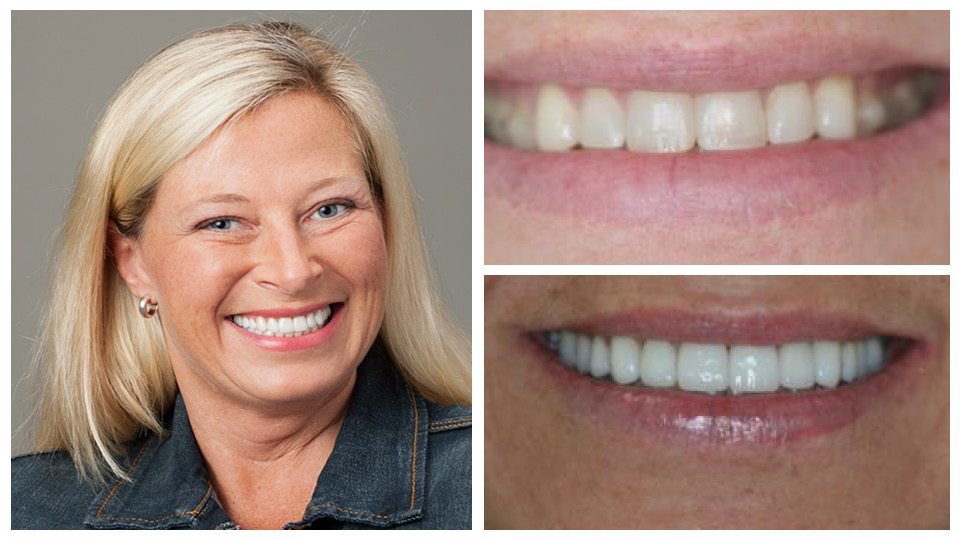 Blond woman wearing earrings smiling with her before and after images next to her