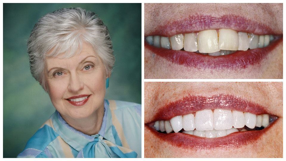 Gray-haired elderly woman smiling with her before and after images next to her