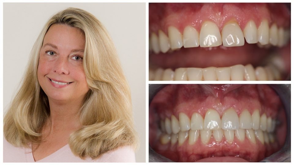 Blond woman smiling with her before and after images next to her
