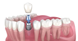 Medically accurate 3D illustration of a dental implant